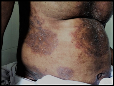 Extensive tinea corporis