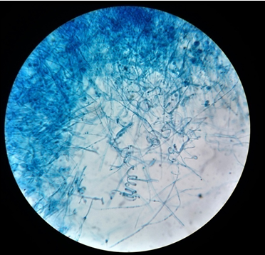 LCB mount of T. mentagrophytes; Spiral hyphae of dermatophytes as seen in Trichophyton. Mentagrophytes (40X)