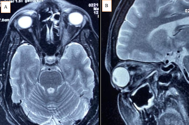 (A & B): MRI of patient having Rhino-orbito-ceribral Mucormycosis showing fungal debri in orbital apex region.