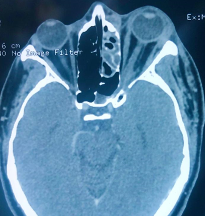 CT-Scan Axial view of patient having Left side Rhino-orbito-ceribral Mucormycosis showing fungal infiltration in left ethmoid sinus and orbital apex leading to proptosis.