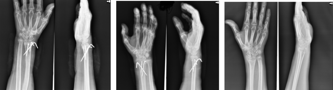 An X-ray of the anteroposterior and lateral presentation after the fixation, 4 weeks and 3 months