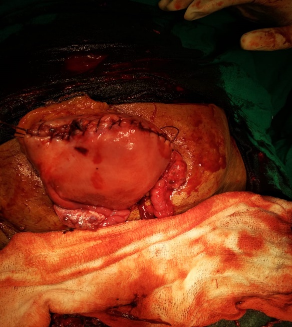 Showing uterus after repair of uterine rent