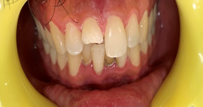 Preoperative photograph showing broken tooth.