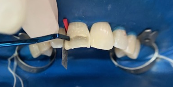 Proximal contact build-up.