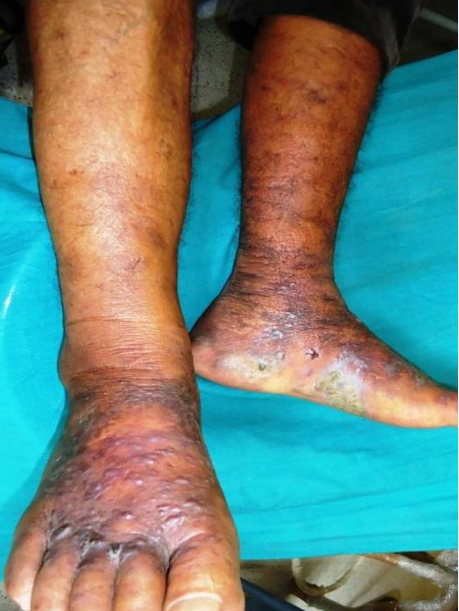 Multiple bluish-black discrete papules and small nodules on lower legs and feet along with bilateral pitting edema.