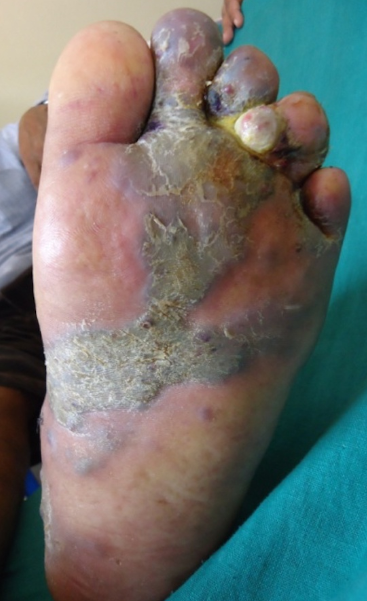 Few indurated, hyperkeratotic plaques with ulceration on left foot.