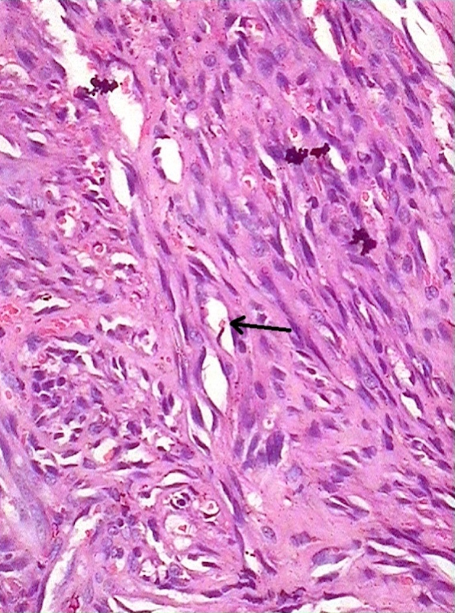 Histopathological examination of the papular lesions on left foot showing densely collagenized dermis with numerous foci displaying plump spindle cells and numerous slit-like spaces containing RBCs lined by spindle cells (black arrow). (H&E, x40)