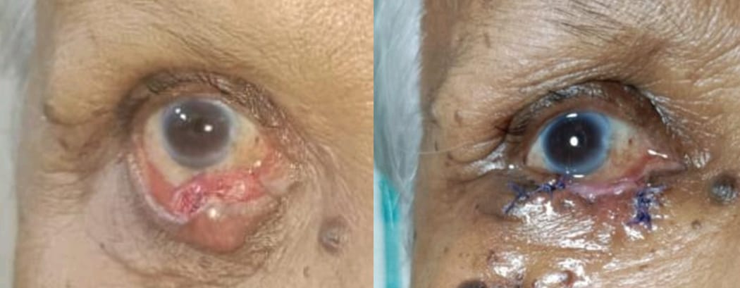 Case 1 Preop - Sebaceous gland carcinoma of right lower lid with loss of eyelashes and ulceration and postop following lid reconstruction with mucus membrane graft from nasal septum for posterior lamellae and sliding skin flap for anterior lamellar reconstruction.
