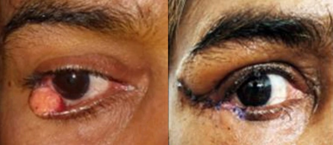 Case 2 Preop - Sebaceous gland carcinoma of right lower lid with loss of eyelashes and ulceration and postop following lid reconstruction by Tenzels semicircular flap technique.