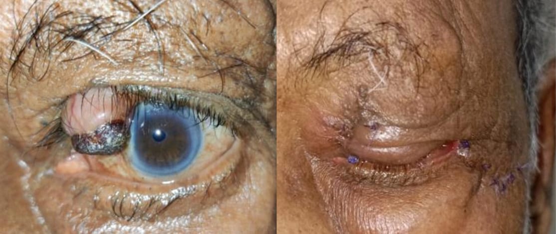 Case 3 Preop Sebaceous gland carcinoma of left upper lid with hemorrhagic crust at the tip of swelling and loss of eyelashes and postop following lid reconstruction with Tenzels semicircular flap technique.