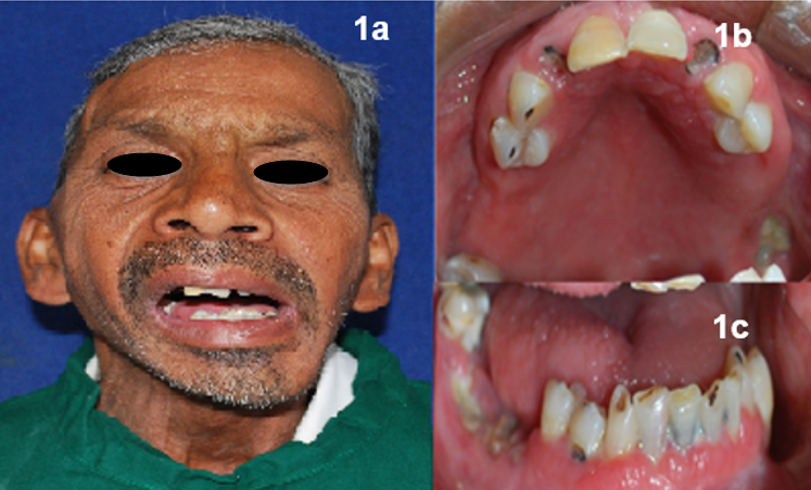 [a. Preoperativeextraoral showing deviation of mandible; b. Intraoral maxillary arch; c. Intraoral mandibular arch]