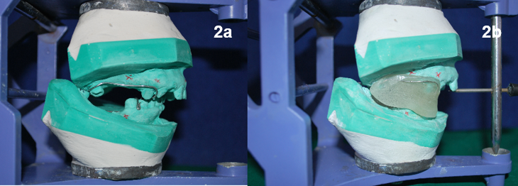 [a. Mounted cast with markings for IMF screws, b.Fabricated mandibular guide flange]