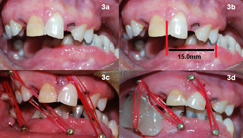 [a.Pre operative intraoral, b. Intraoral showing deviation of mandible towards left c. IMF screws placed, d. IMF screws and guide flange prosthesis in-situ] deviation corrected