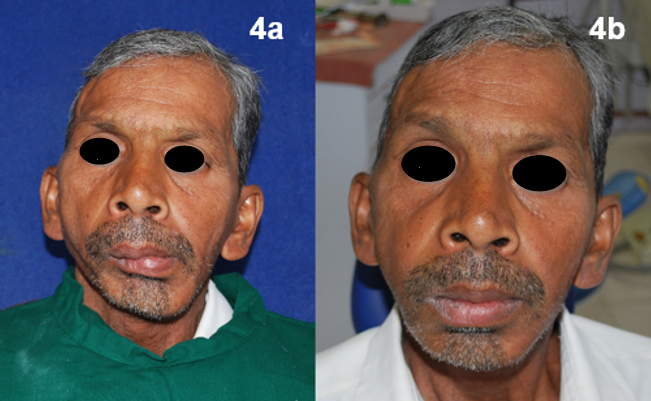 [a.Pre operativeextraoral b.Post operativeextraoral]