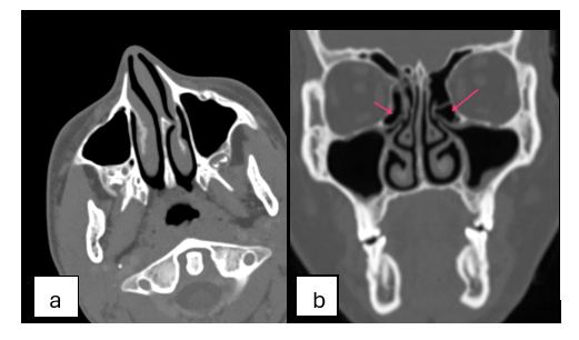 Anatomic Variations of Paranasal Sinuses and Nasal Cavity based on CT Scan and it’s Clinical Correlation