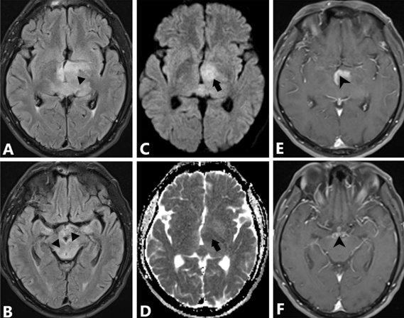 Magnetic Resonance Imaging of Brain– Fluid attenuated inversion recovery images; A,B: Showing hyperintensities in the thalamus; A: Triangle head) and mid-brain; B: Triangle head). Diffusion-weighted imaging; C: showing diffusion restriction in medial thalamus (left more than right – arrows) with Apparent diffusion coefficient; D: consistent with acute infarct. T1 weighted post-contrast images; E,F: showing contrast enhancement with conglomerate ring lesions.