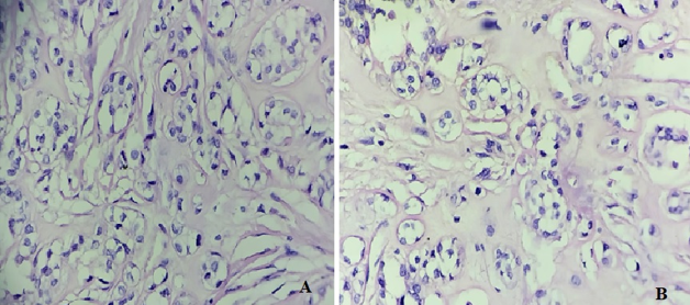Microscopic examination (high magnification); A&B: The nests and trabeculae were separated by fibro-myxoid stroma with areas showing hyalinization. Tumour cells are large, spindled-epithelioid with eosinophilic-clear cytoplasm and uniform nucleus. Few cells showed prominent cytoplasmic vacuolations. (Haematoxylin and eosin stain; 40X)