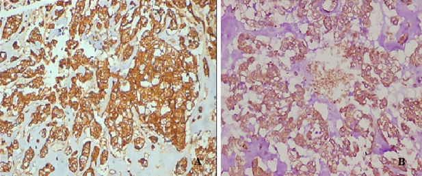 Immunohistochemical study; A: Tumour cells show diffuse strong positivity for S-100 protein. (40X magnification). B: Immunohistochemical study- Tumour cells show diffuse strong positivity for myogenic marker Calponin. (40X magnification)