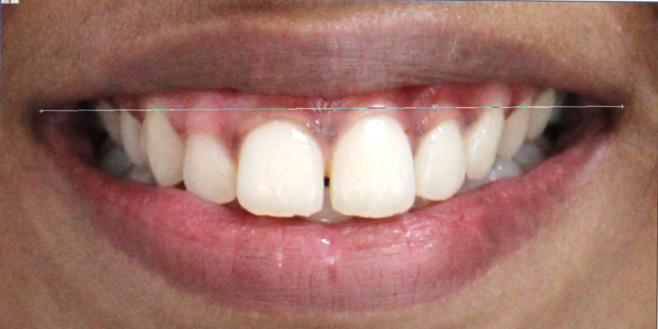 Intercommissural width