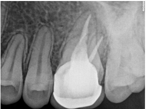 Crown cementation