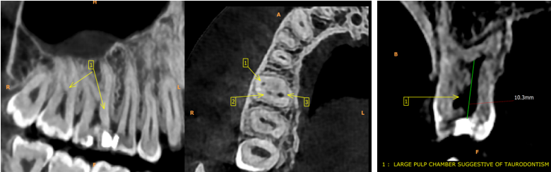 Pre-Operative CBCT scan