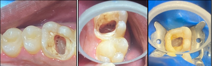 Access cavity