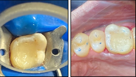 Composite restoration