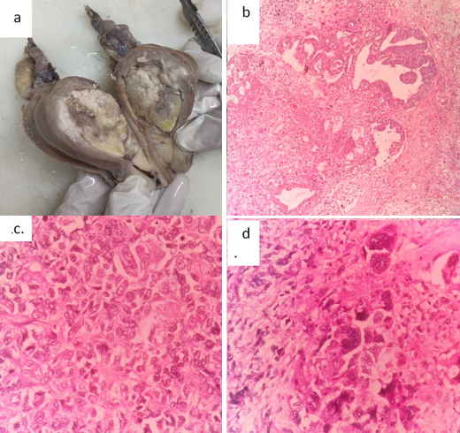 a: Gross image showing dilated endometrial cavity with a friable, polypoidal mass; b: Histopathological examination showing epithelial component arranged in glandular pattern (H&E, 100X); c and d: Undifferentiated sarcomatous component arranged in sheets (c) and bizarre forms (d) (H&E, 400X)