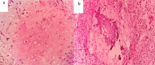 Histopathological examination showing heterologous chondrosarcomatous element (a) Bone formation (b) (H&E, 400X)