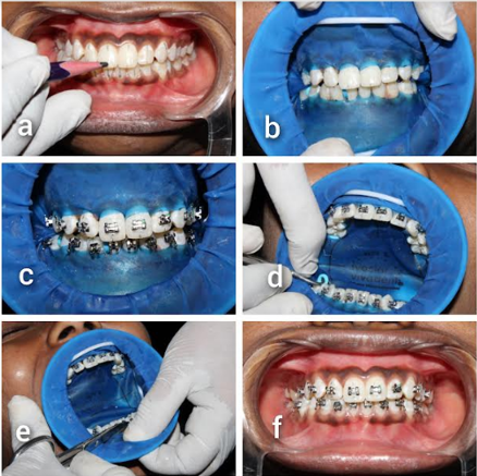 Bonding using rubber dam