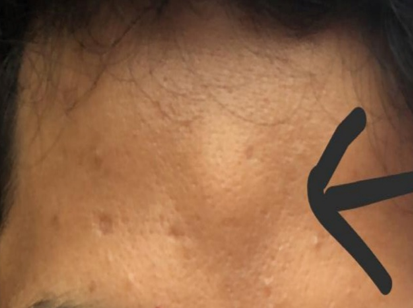 Showing subcutaneous swelling over forehead (Arrow marked)