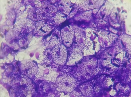 Sheets and clusters of coarsely multivacuolated fat cells displaying small central nuclei (H &E 400X)