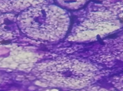 Fat in brown fat cells distributed throughout the cytoplasm in multiple small vacuoles and cells appropriately called Mulberry cells.(H &E 1000X)