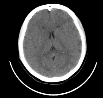 CT brain plain showing no abnormality.