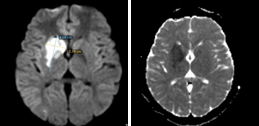 MRI brain showing diffusion restriction in right caudate, putamen and anterior limb of internal capsule with ADC reversal suggesting infarct.