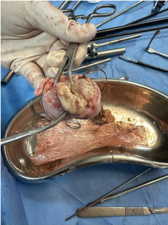 Specimen extracted during surgery showing the right dermoid cyst and its contents which shows hair and tooth