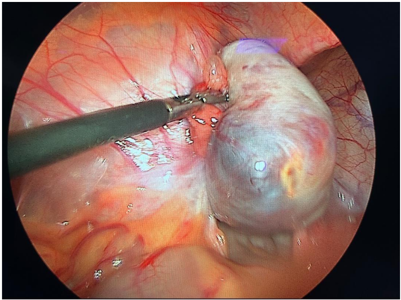 Intraoperative finding of the right dermoid cyst before the oophorectomy