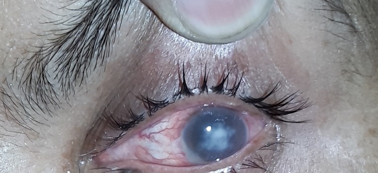 Post-op 5th week photo of 40 years old female