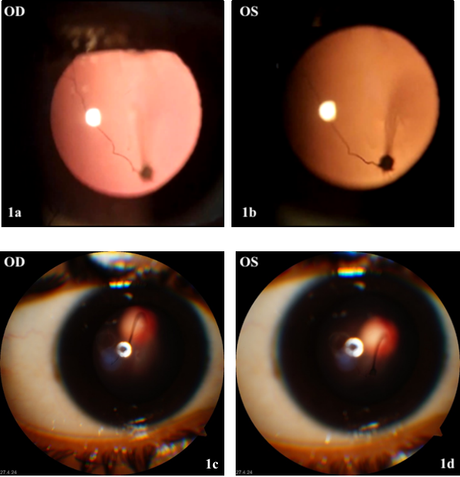a,c): Slit lamp examination of the right eye. b,d): Slit lamp examination of the left eye. Both eyes show greyish band originating from optic disc and projecting into vitreous cavity on retro-illumination