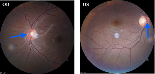 Fundus photography of both eyes showing a well attached retina and a greyish band emanating from the optic disc into the vitreous (Blue arrow)