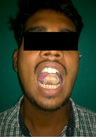 Initial lesion after the snake bite on tongue