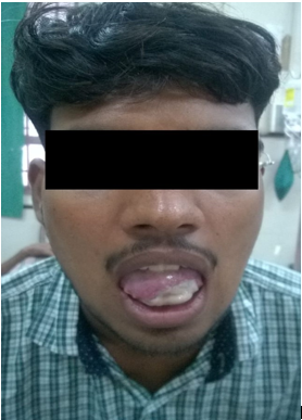 Lesion resolving 2 weeks after the initiation of treatment