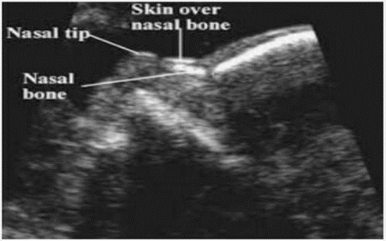 Normal nasal bone on ultrasound 