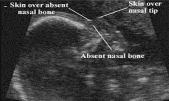 Absent nasal bone on ultrasound