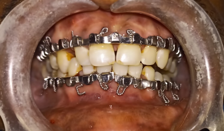 Conventional Erich’s arch bar