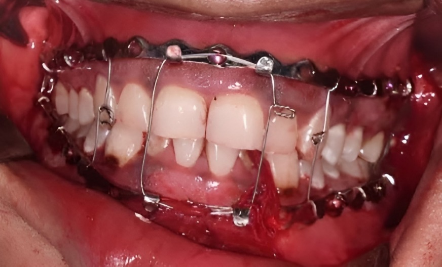 MMF done with modified screw retained arch bar