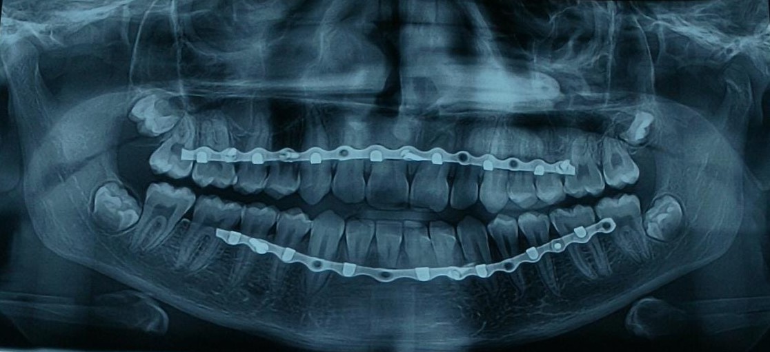 Orthopantomogram image of modified screw retained arch bar in a patient