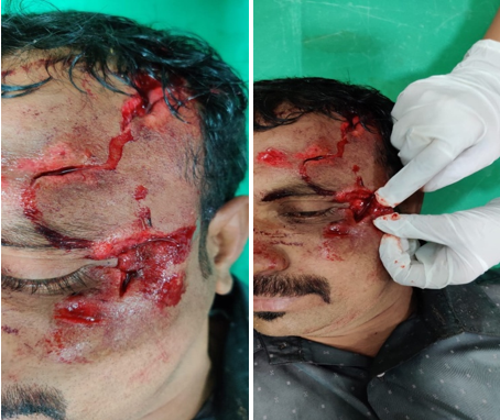 Patient with road traffic accident having a lacerated wound in he lateral canthal region and in the lateral part of the forehead. Patient had associated fracture of the lateral orbital wall.