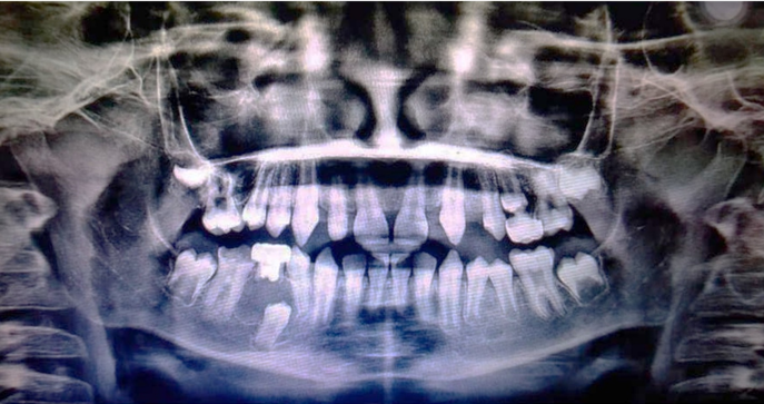 Orthopantomogram showing a well-defined unilocular radiolucency surrounding the neck of the crown of the unerupted mandibular right second premolar