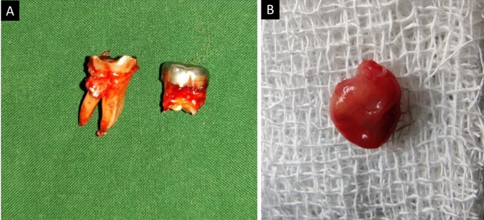 A) Extracted mandibular right permanent first molar and deciduous second molar; B) Enucleated lesion in toto